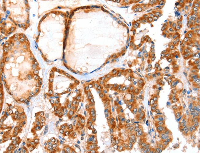 ACOX1 / ACOX Antibody - Immunohistochemistry of paraffin-embedded Human thyroid cancer using ACOX1 Polyclonal Antibody at dilution of 1:40.