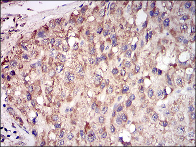 ACP5 / TRAP Antibody - IHC of paraffin-embedded liver cancer tissues using ACP5 mouse monoclonal antibody with DAB staining.