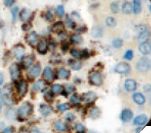 ACP5 / TRAP Antibody - IHC of TRAcP on FFPE Hairy Cell Leukemia tissue. This image was taken for the unmodified form of this product. Other forms have not been tested.