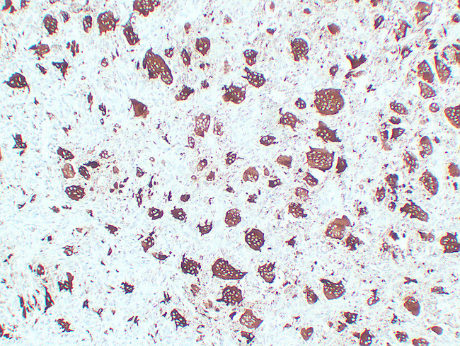ACP5 / TRAP Antibody - Giant Cell Tumor 1