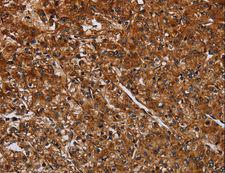 ACP6 Antibody - Immunohistochemistry of paraffin-embedded Human prostate cancer using ACP6 Polyclonal Antibody at dilution of 1:30.