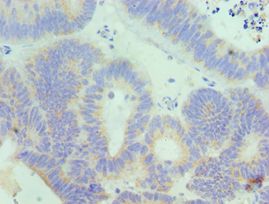 AcPL / IL18RAP Antibody - Immunohistochemistry of paraffin-embedded human colon cancer using antibody at 1:100 dilution.