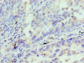 AcPL / IL18RAP Antibody - Immunohistochemistry of paraffin-embedded human lung cancer using antibody at 1:100 dilution.