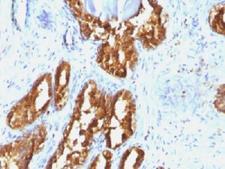 ACPP / PAP Antibody - IHC testing of human prostate carcinoma with PSAP antibody (clone ACCP/1338). Required HIER: boil tissue sections in 10mM citrate buffer, pH 6, for 10-20 min followed by cooling at RT for 20 min.