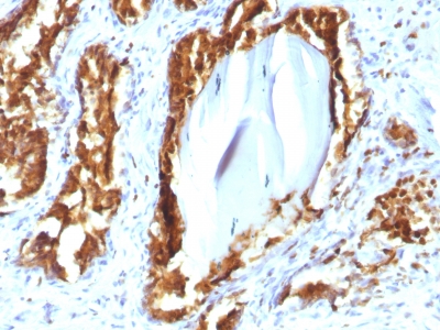 ACPP / PAP Antibody - Formalin-fixed, paraffin-embedded human Prostate Carcinoma stained with PSAP Mouse Recombinant Monoclonal Antibody (rACPP/1338).