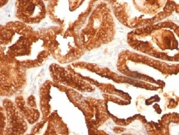 ACPP / PAP Antibody - IHC testing of human prostate carcinoma with PSAP antibody (clone SPM312). Required HIER: boil tissue sections in 10mM citrate buffer, pH 6, for 10-20 min followed by cooling at RT for 20 min.