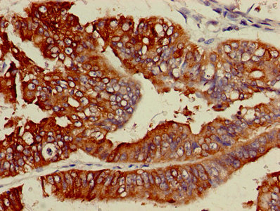 ACS5 / ACSL5 Antibody - IHC image of ACSL5 Antibody diluted at 1:600 and staining in paraffin-embedded human endometrial cancer performed on a Leica BondTM system. After dewaxing and hydration, antigen retrieval was mediated by high pressure in a citrate buffer (pH 6.0). Section was blocked with 10% normal goat serum 30min at RT. Then primary antibody (1% BSA) was incubated at 4°C overnight. The primary is detected by a biotinylated secondary antibody and visualized using an HRP conjugated SP system.
