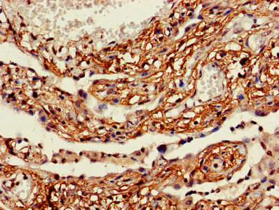 ACS5 / ACSL5 Antibody - IHC image of ACSL5 Antibody diluted at 1:600 and staining in paraffin-embedded human lung cancer performed on a Leica BondTM system. After dewaxing and hydration, antigen retrieval was mediated by high pressure in a citrate buffer (pH 6.0). Section was blocked with 10% normal goat serum 30min at RT. Then primary antibody (1% BSA) was incubated at 4°C overnight. The primary is detected by a biotinylated secondary antibody and visualized using an HRP conjugated SP system.