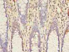 ACS5 / ACSL5 Antibody - Immunohistochemistry of paraffin-embedded human colon cancer using antibody at dilution of 1:100.
