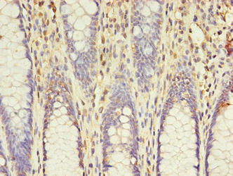 ACS5 / ACSL5 Antibody - Immunohistochemistry of paraffin-embedded human colon cancer using ACSL5 Antibody at dilution of 1:100