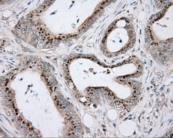 ACSBG1 / hsBG Antibody - Immunohistochemical staining of paraffin-embedded Adenocarcinoma of Human colon tissue using anti-ACSBG1 mouse monoclonal antibody.