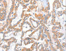 ACSBG1 / hsBG Antibody - Immunohistochemistry of paraffin-embedded Human colon cancer using ACSBG1 Polyclonal Antibody at dilution of 1:40.