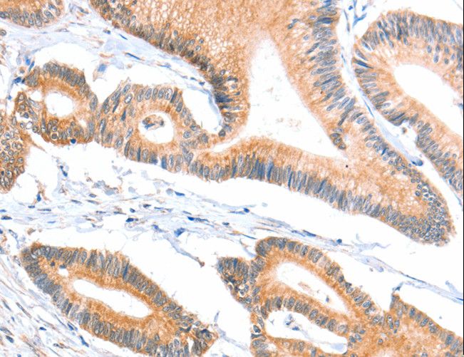 ACSBG1 / hsBG Antibody - Immunohistochemistry of paraffin-embedded Human colon cancer using ACSBG1 Polyclonal Antibody at dilution of 1:40.