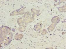 ACSBG2 Antibody - Immunohistochemistry of paraffin-embedded human gastric cancer using antibody at dilution of 1:100.