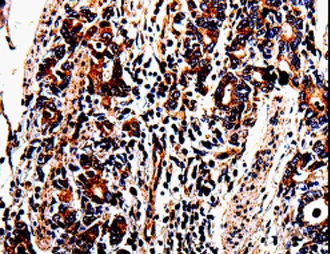 ACSBG2 Antibody - Immunohistochemistry of paraffin-embedded Human lung cancer using ACSBG2 Polyclonal Antibody at dilution of 1:60.