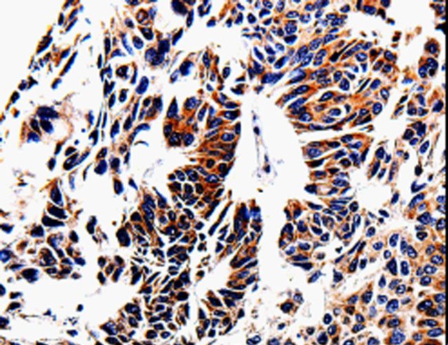ACSBG2 Antibody - Immunohistochemistry of paraffin-embedded Human lung cancer using ACSBG2 Polyclonal Antibody at dilution of 1:60.