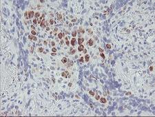 ACSF2 Antibody - IHC of paraffin-embedded Carcinoma of Human lung tissue using anti-ACSF2 mouse monoclonal antibody.