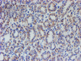ACSF2 Antibody - IHC of paraffin-embedded Carcinoma of Human thyroid tissue using anti-ACSF2 mouse monoclonal antibody.