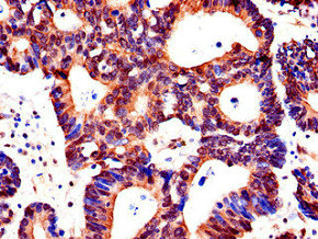 ACSF2 Antibody - Immunohistochemistry of paraffin-embedded human colon cancer using ACSF2 Antibody at dilution of 1:100