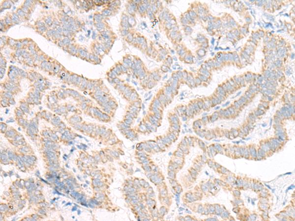ACSF2 Antibody - Immunohistochemistry of paraffin-embedded Human thyroid cancer tissue  using ACSF2 Polyclonal Antibody at dilution of 1:30(×200)