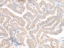 ACSF2 Antibody - Immunohistochemistry of paraffin-embedded Human thyroid cancer tissue  using ACSF2 Polyclonal Antibody at dilution of 1:30(×200)