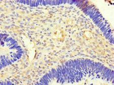 ACSF3 Antibody - Immunohistochemistry of paraffin-embedded human ovarian cancer at dilution of 1:100