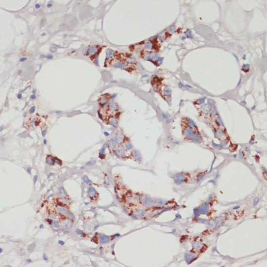 ACSL3 Antibody - Immunohistochemistry of paraffin-embedded Human mammary cancer using ACSL3 Polyclonal Antibody at dilution of 1:100 (40x lens).