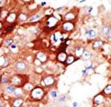 ACSL4 / FACL4 Antibody - Formalin-fixed and paraffin-embedded human cancer tissue reacted with the primary antibody, which was peroxidase-conjugated to the secondary antibody, followed by DAB staining. This data demonstrates the use of this antibody for immunohistochemistry; clinical relevance has not been evaluated. BC = breast carcinoma; HC = hepatocarcinoma.