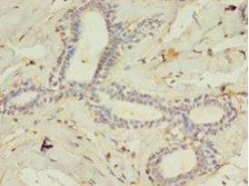 ACSL4 / FACL4 Antibody - Immunohistochemistry of paraffin-embedded human breast cancer tissue using antibody at 1: 100 dilution.  This image was taken for the unconjugated form of this product. Other forms have not been tested.