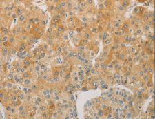 ACSL4 / FACL4 Antibody - Immunohistochemistry of paraffin-embedded Human liver cancer using ACSL4 Polyclonal Antibody at dilution of 1:60.