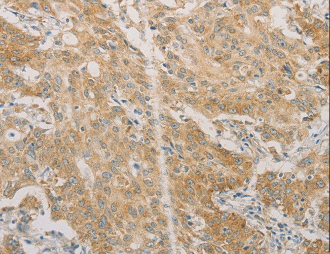 ACSL4 / FACL4 Antibody - Immunohistochemistry of paraffin-embedded Human gastric cancer using ACSL4 Polyclonal Antibody at dilution of 1:60.