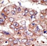 ACSL6 Antibody - Formalin-fixed and paraffin-embedded human cancer tissue reacted with the primary antibody, which was peroxidase-conjugated to the secondary antibody, followed by AEC staining. This data demonstrates the use of this antibody for immunohistochemistry; clinical relevance has not been evaluated. BC = breast carcinoma; HC = hepatocarcinoma.
