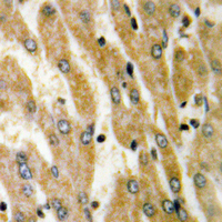 ACSL6 Antibody - Immunohistochemical analysis of ACSL6 staining in human liver cancer formalin fixed paraffin embedded tissue section. The section was pre-treated using heat mediated antigen retrieval with sodium citrate buffer (pH 6.0). The section was then incubated with the antibody at room temperature and detected using an HRP conjugated compact polymer system. DAB was used as the chromogen. The section was then counterstained with hematoxylin and mounted with DPX.