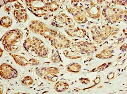 ACSM3 / SAH Antibody - Immunohistochemistry of paraffin-embedded human breast cancer using antibody at 1:100 dilution.