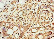 ACSM3 / SAH Antibody - Immunohistochemistry of paraffin-embedded human breast cancer using antibody at 1:100 dilution.