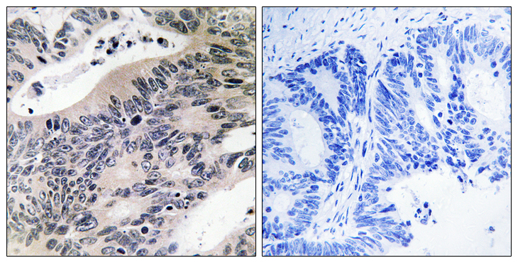 ACSS1 Antibody - Immunohistochemistry analysis of paraffin-embedded human colon carcinoma tissue, using ACSS1 Antibody. The picture on the right is blocked with the synthesized peptide.