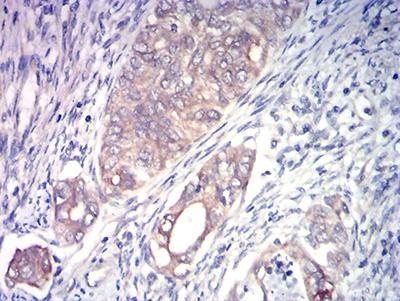 ACSS1 Antibody - Immunohistochemical analysis of paraffin-embedded cervical cancer tissues using ACSS1 mouse mAb with DAB staining.