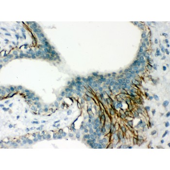 ACTA1 / Skeletal Muscle Actin Antibody - Actin antibody IHC-paraffin. IHC(P): Human Mammary Cancer Tissue.