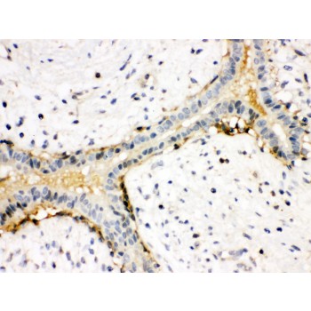 ACTA1 / Skeletal Muscle Actin Antibody - ACTIN antibody IHC-paraffin. IHC(P): Human Mammary Cancer Tissue.