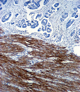 ACTA1 / Skeletal Muscle Actin Antibody - ACTA1 Antibody immunohistochemistry of formalin-fixed and paraffin-embedded human colon carcinoma followed by peroxidase-conjugated secondary antibody and DAB staining.