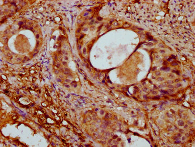 ACTA1 / Skeletal Muscle Actin Antibody - IHC image of ACTA1 Antibody diluted at 1:400 and staining in paraffin-embedded human cervical cancer performed on a Leica BondTM system. After dewaxing and hydration, antigen retrieval was mediated by high pressure in a citrate buffer (pH 6.0). Section was blocked with 10% normal goat serum 30min at RT. Then primary antibody (1% BSA) was incubated at 4°C overnight. The primary is detected by a biotinylated secondary antibody and visualized using an HRP conjugated SP system.