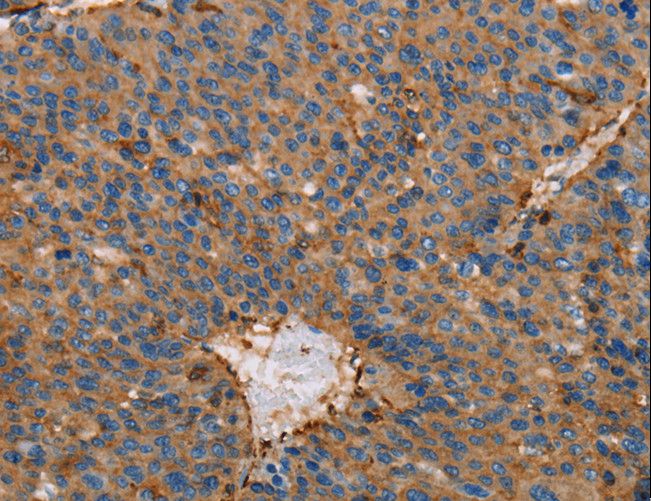 ACTA1 / Skeletal Muscle Actin Antibody - Immunohistochemistry of paraffin-embedded Human liver cancer using ACTA1 Polyclonal Antibody at dilution of 1:65.