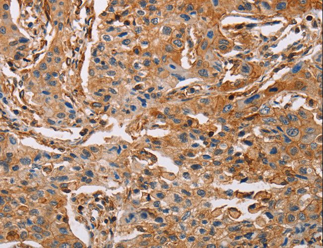 ACTA1 / Skeletal Muscle Actin Antibody - Immunohistochemistry of paraffin-embedded Human lung cancer using ACTA1 Polyclonal Antibody at dilution of 1:65.