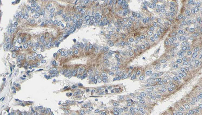 ACTA1 / Skeletal Muscle Actin Antibody - 1:100 staining human prostate tissue by IHC-P. The sample was formaldehyde fixed and a heat mediated antigen retrieval step in citrate buffer was performed. The sample was then blocked and incubated with the antibody for 1.5 hours at 22°C. An HRP conjugated goat anti-rabbit antibody was used as the secondary.