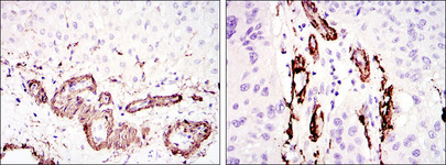 ACTA2 / Smooth Muscle Actin Antibody - IHC of paraffin-embedded liver tissues (left) and lung cancer tissues (right) using ACTA2 mouse monoclonal antibody with DAB staining.