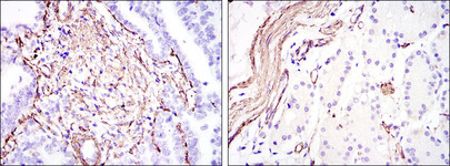 ACTA2 / Smooth Muscle Actin Antibody - IHC of paraffin-embedded stomach cancer (left) and stomach tissues (right) using ACTA2 mouse monoclonal antibody with DAB staining.