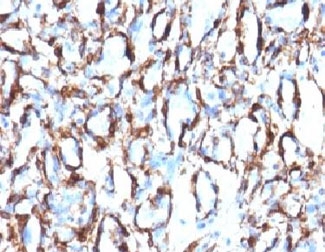 ACTA2 / Smooth Muscle Actin Antibody - Formalin-fixed, paraffin-embedded human angiosarcoma stained with alpha Smooth Muscle Actin antibody (ACTA2/791).  This image was taken for the unmodified form of this product. Other forms have not been tested.