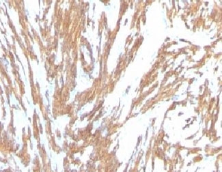 ACTA2 / Smooth Muscle Actin Antibody - Formalin-fixed, paraffin-embedded human Leiomyosarcoma stained with alpha Smooth Muscle Actin antibody (ACTA2/791).  This image was taken for the unmodified form of this product. Other forms have not been tested.
