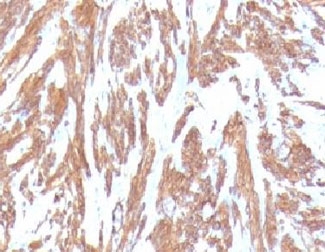 ACTA2 / Smooth Muscle Actin Antibody - IHC testing of FFPE human leiomyosarcoma with Smooth Muscle Actin antibody (clone SMAT2-1).  This image was taken for the unmodified form of this product. Other forms have not been tested.
