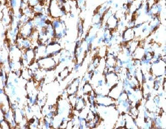 ACTA2 / Smooth Muscle Actin Antibody - IHC testing of FFPE human angiosarcoma with Smooth Muscle Actin antibody (clone SMAT2-1).  This image was taken for the unmodified form of this product. Other forms have not been tested.
